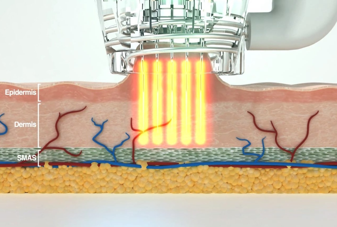 Skin Texturizing Treatment