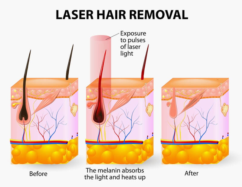 Laser Hair Removal